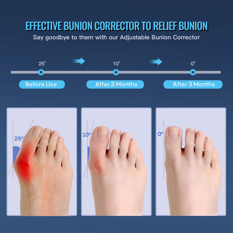 Bunion Corrector for Women Big Toe Upgraded Orthopedic Bunyon Splint w/Brace - Comfortable Foot Straightener 2PC